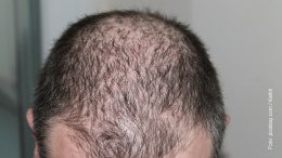 Männerkopf mit Haarausfall